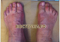 Клинический результат до операции
