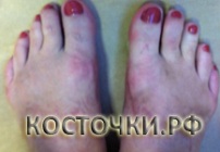 Клинический результат до операции