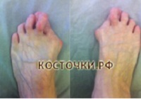 Клинический результат до операции