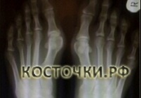 Клинический результат до операции