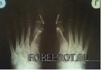 Клинический результат до операции