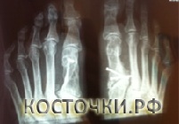 Клинический результат до операции